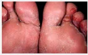 Cara Sembuhkan Eksim Dan Kudis Di Kaki Dengan Ramuan Alami Kumparan Com