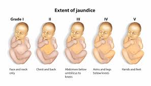 Image result for Vacuum Caput