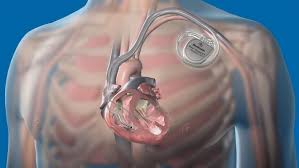 But what's the difference between the two? Advances In Implantable Cardioverter Defibrillator Technology Daic