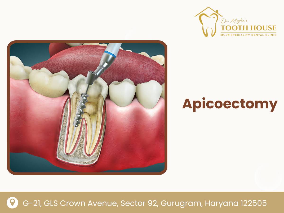Apicoectomy product image