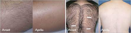 Request any service, anywhere with intently.co. Laser Hair Removal Clinique Laserzone Montreal