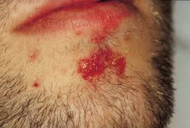 Sykdommen er forårsaket av bakterier og gir sår og blemmer i huden. Infeksjoner Med Gruppe A Streptokokker I Hud Blotdeler Og Blod Tidsskrift For Den Norske Legeforening