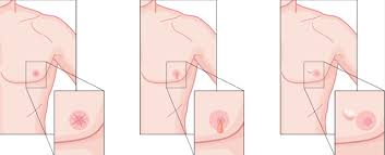 Male breast cancer symptoms can be similar to those experienced by women and may include: Breast Cancerby
