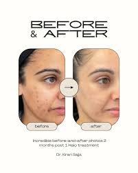 ✨ Before & After Spotlight ✨ These results speak for themselves. Just 2  months after a single Halo treatment, our patient's skin shows remarkable  improvement in tone, texture, and overall radiance. Performed