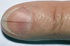 Chimiothérapie most cancers de la vessie. Ligne Noir Sur L Ongle Naturel Forum Manucure Nail Art Et Ongle