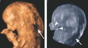 Image result for Micrognathia