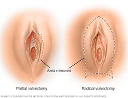 A cancer may also cause symptoms like fever, extreme tiredness ( fatigue ), or weight loss. Cancer Treatment For Women Possible Sexual Side Effects Mayo Clinic