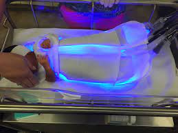 Maybe you would like to learn more about one of these? Innovative Phototherapy Sleep Sack Could Be A Game Changer In Treating Newborn Jaundice University Hospitals