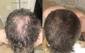 If hair follicles are damaged, the loss can be permanent. The Best Before After Microneedling And Derma Roller Results For Hair Hairliciously