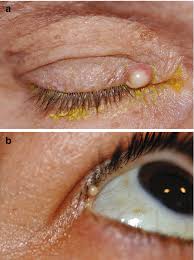 Image result for milium cyst on eyelid