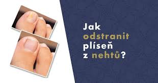 Image result for mykoza nehtů