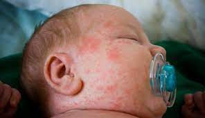 Pada dasarnya luka bekas gigitan nyamuk memang menyebabkan gatal yang tidak nyaman. Cara Alami Mengatasi Bentol Karena Gigitan Nyamuk Popmama Com