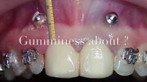 We use orthodontics mechanics to intrude and distalized the maxilla. Correcting Gummy Smile With Tads Youtube