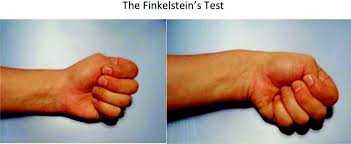 Image result for Intersection Syndrome