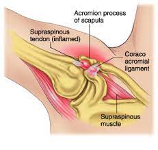 The Difference Between External And Internal Impingement Of The Shoulder