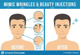 Botox antes y despues is of interest to you? Botox Cosmetico De Los Procedimientos Ilustracion Del Vector Ilustracion De Vector Cosmetico 126794606