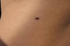 If you have skin cancer, it is important to know which type you have because it affects your treatment options and your outlook (prognosis). Is It Normal For A New Mole To Appear Causes And Warning Signs