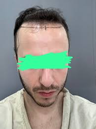 3491 Grafts Post-Op Update- Dr. Ratchathorn Panchaprateep (Absolute Hair  Clinic, Bangkok) : r/HairTransplants