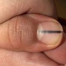 Weisse flecken auf dem fingernagel rührt meistens von einer verletztung. Haben Sie Diesen Streifen Auf Dem Fingernagel Ist Es Gefahrlich Gesundheit