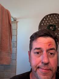 Golfer injured by stray ball