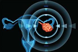 Long Term Survival Rates Remain Poor For Epithelial Ovarian Cancer