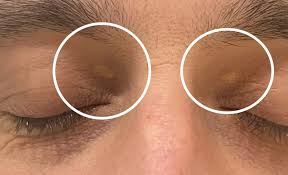 Image result for xantelasma