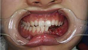 Osteosarcoma and undifferentiated pleomorphic sarcoma (ups) (formerly called malignant fibrous histiocytoma mfh) of bone treatment depends on site, extent of disease, and grade. Misdiagnosis Of Osteosarcoma As Cementoblastoma From An Atypical Mandibular Swelling A Case Report