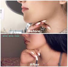 The hyaluron pen can be used to create volume, shape and lift. Laser Tattoo Removal Ny Bye Bye Ink Needle Free Filler
