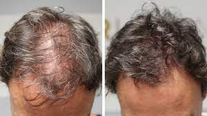 Apr 22, 2020 · healthy diets that are rich in vitamins, minerals and other nutrients can help improve your hair density and texture. Adding Hair Density With Scalp Micropigmentation Hairline Ink