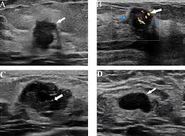 I have inflammatory breast cancer which was firstly diagnosed as mastitis in jan 09. Frontiers Nomograms For Predicting Axillary Lymph Node Status Reconciled With Preoperative Breast Ultrasound Images Oncology