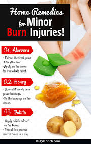 In This Post We Are Giving Some Of The Effective Home Remedies For Burns Which Will Not Only Provide Relief Home Remedies For Burns Herbal Remedies Remedies