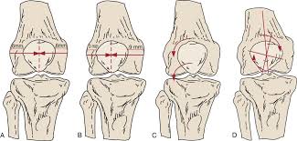 Image result for Patella Mobility Test