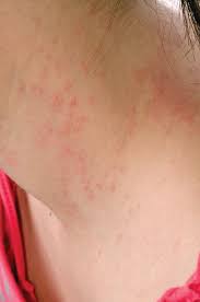 Image result for Atopic Dermatitis