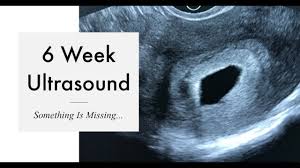 Miscarriage 6 week ultrasound pictures. 6 Week Ultrasound Something Is Missing Youtube