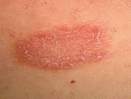Consult a doctor for medical advice. Pityriasis Rosea Dermnet Nz