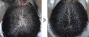 Does it cause hair loss? Mount And Blade Oily Scalp And Hair Loss