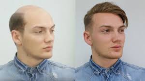 With Hair Replacement A Person Get What He She Pays For Sac Dokulmesi Sac Yeni Sac