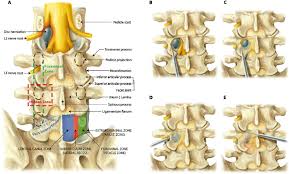 Lumbar Anatomy And Surgical Approaches To The Hidden Zone A Overview Download Scientific Diagram