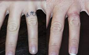 We did not find results for: Limited Tattoo Excision Tattoo Removal Surgery Gainesville Florida