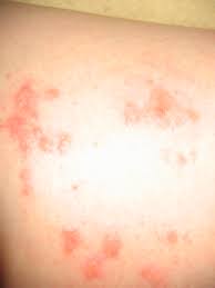 My Story The Adventures Of Sensitive Skin Girl