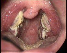 Dec 01, 2020 · die ursachen für schmerzende und geschwollene lymphknoten am hals, unter den armen oder an der leiste sind meist harmlos. Pfeiffer Drusenfieber Wikipedia