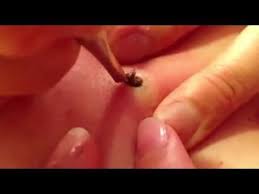 Envie d'éliminer vos points noirs immédiatement ? Elle Enleve Un Point Noir Qui Lui Bouche Un Pore Sur La Peau Depuis 20 Ans Youtube