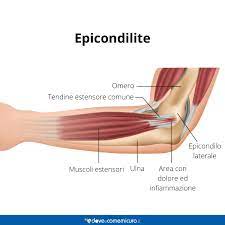 Gomito Del Tennista Epicondilite Sintomi Cura Esercizi