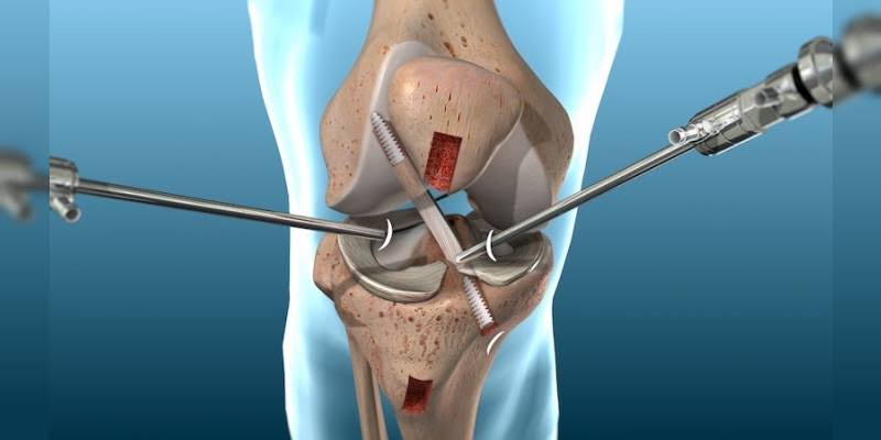 Arthroscopy product image