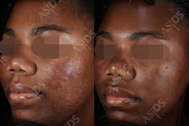 In minutes, acids lift away dead cells and trigger a lovely chain reaction: Chemical Peels For Acne Scars