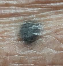 Image result for Blue Nevus