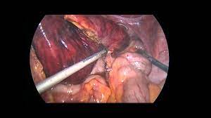 Das häufigste krankheitsbild in dieser kategorie ist eine darmlähmung oder reflektorischer darmstillstand (paralytischer ileus) auf grund von erkrankungen im bauch, nach operationen im bauch oder an der wirbelsäule sowie nach einnahme von gewissen medikamenten (opioidhaltige schmerzmittel). Darmverschluss Dunndarmileus Youtube