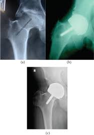 Physical measurements of the thigh muscles and exams to assess the kids' range of motion are also performed as part of diagnosis. Perthes Disease An Overview Sciencedirect Topics