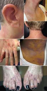 Image result for Atopic Patient