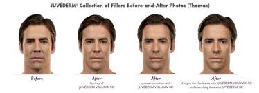 Juvederm before and after pics reveal how hyaluronic acid fillers effectively fill in fine lines and wrinkles, and add youthful contours by plumping lips, or replacing volume loss in the cheek area. What Can Juvederm Do For You Utah Facial Plastics